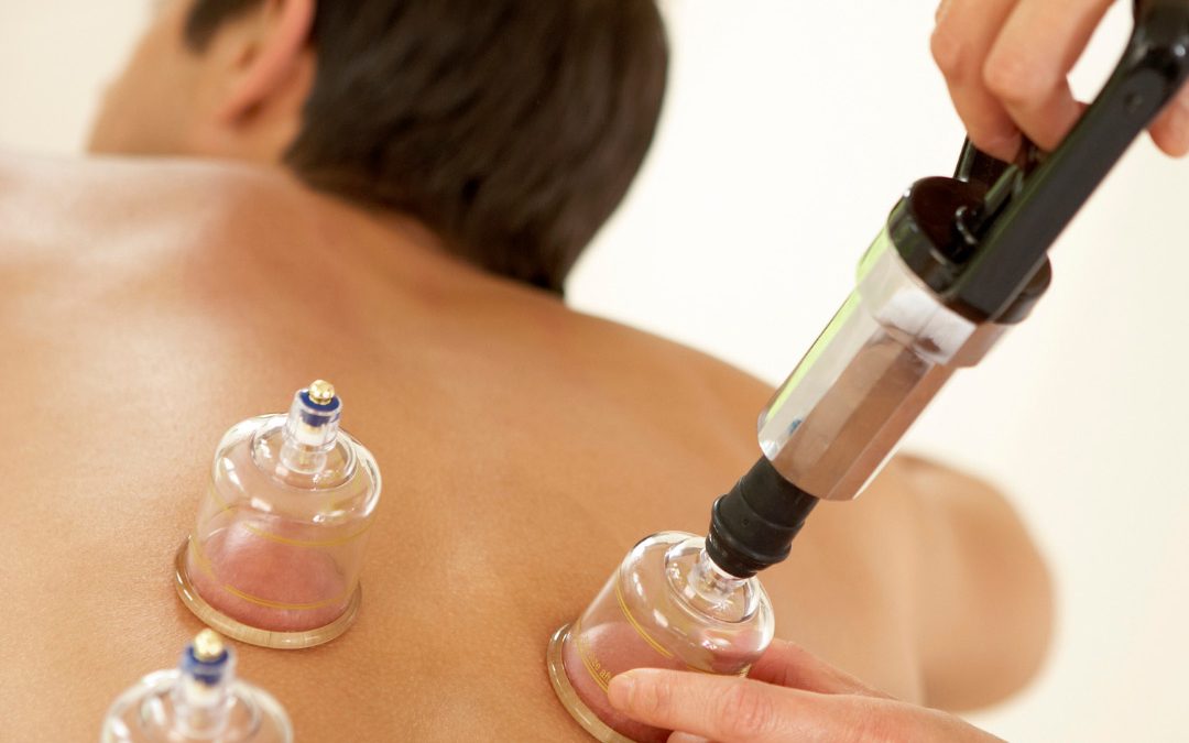 3 Reasons to Try Cupping