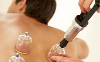 3 Reasons to Try Cupping